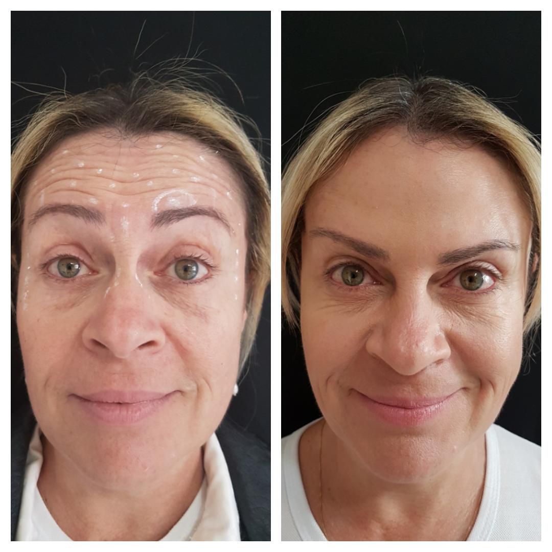 Harmonização Orofacial em Ribeirão Preto