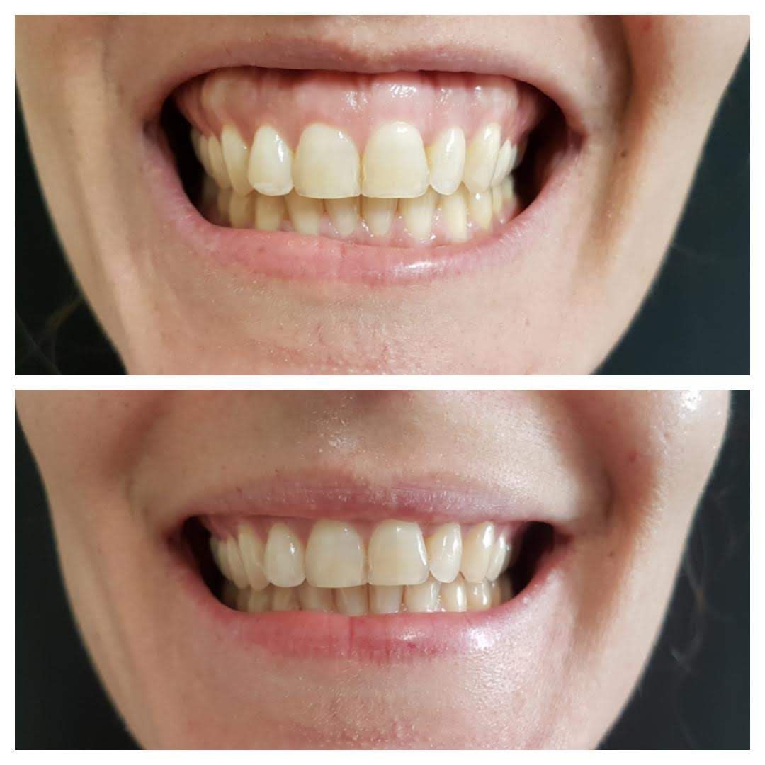 Resultado de harmonização facial — Clínica Essenziale