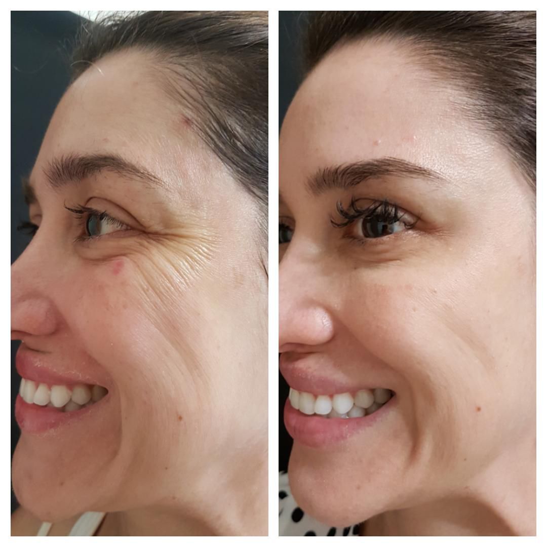 Resultado de harmonização facial — Clínica Essenziale