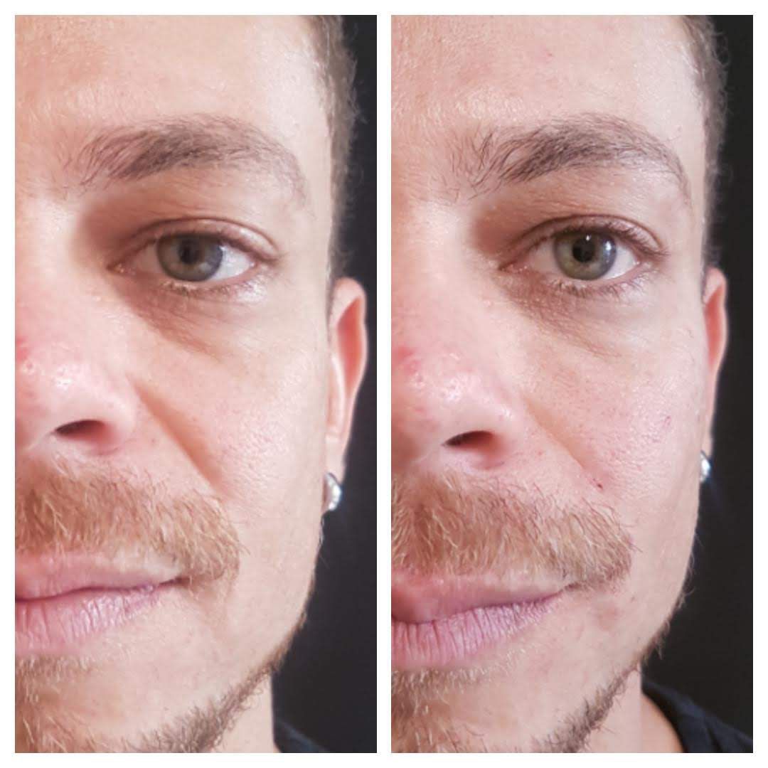Resultado de harmonização facial — Clínica Essenziale