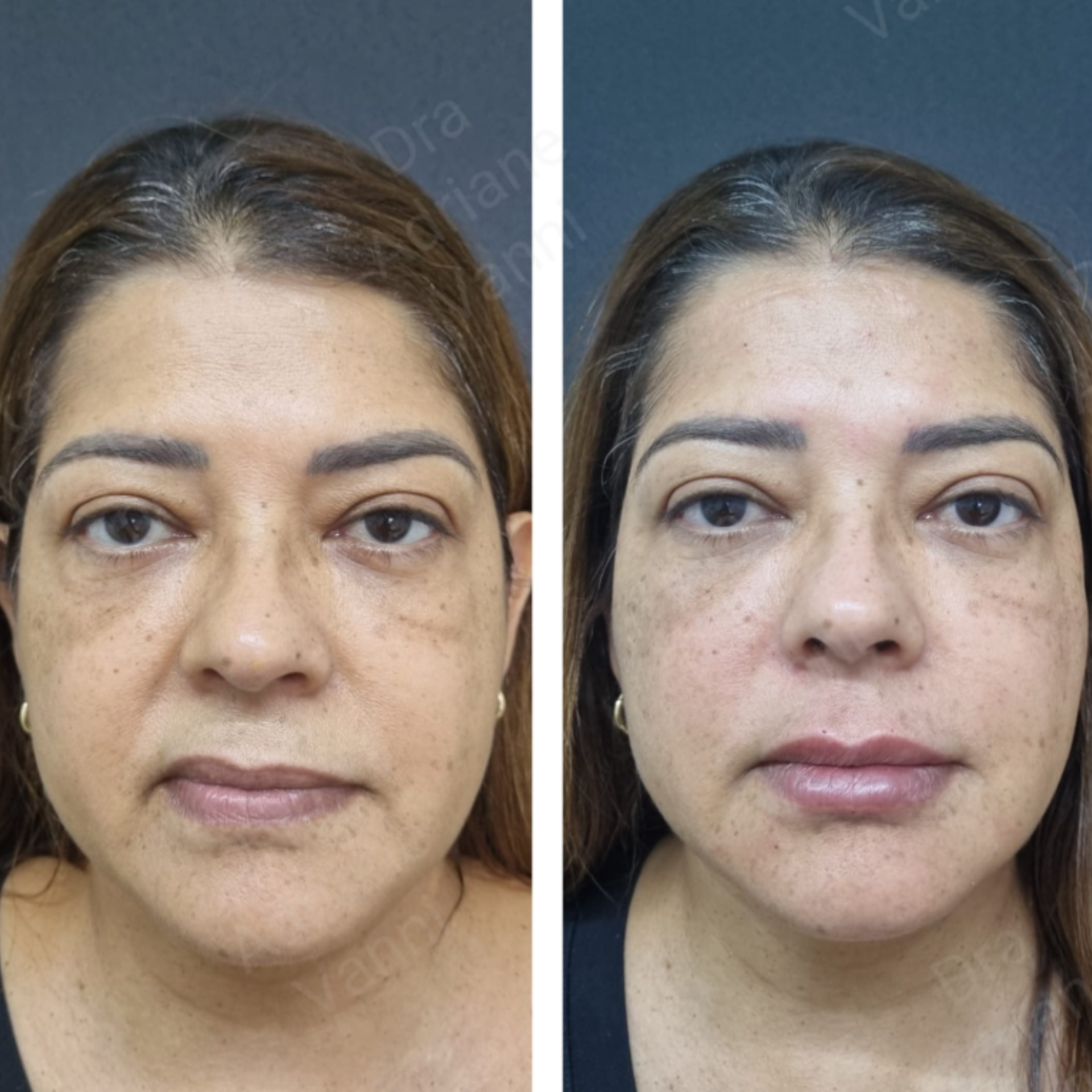 Resultado de harmonização facial — Clínica Essenziale