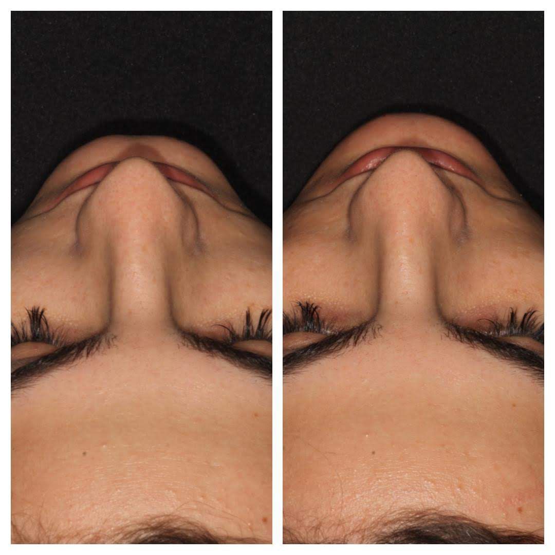 Resultado de harmonização facial — Clínica Essenziale
