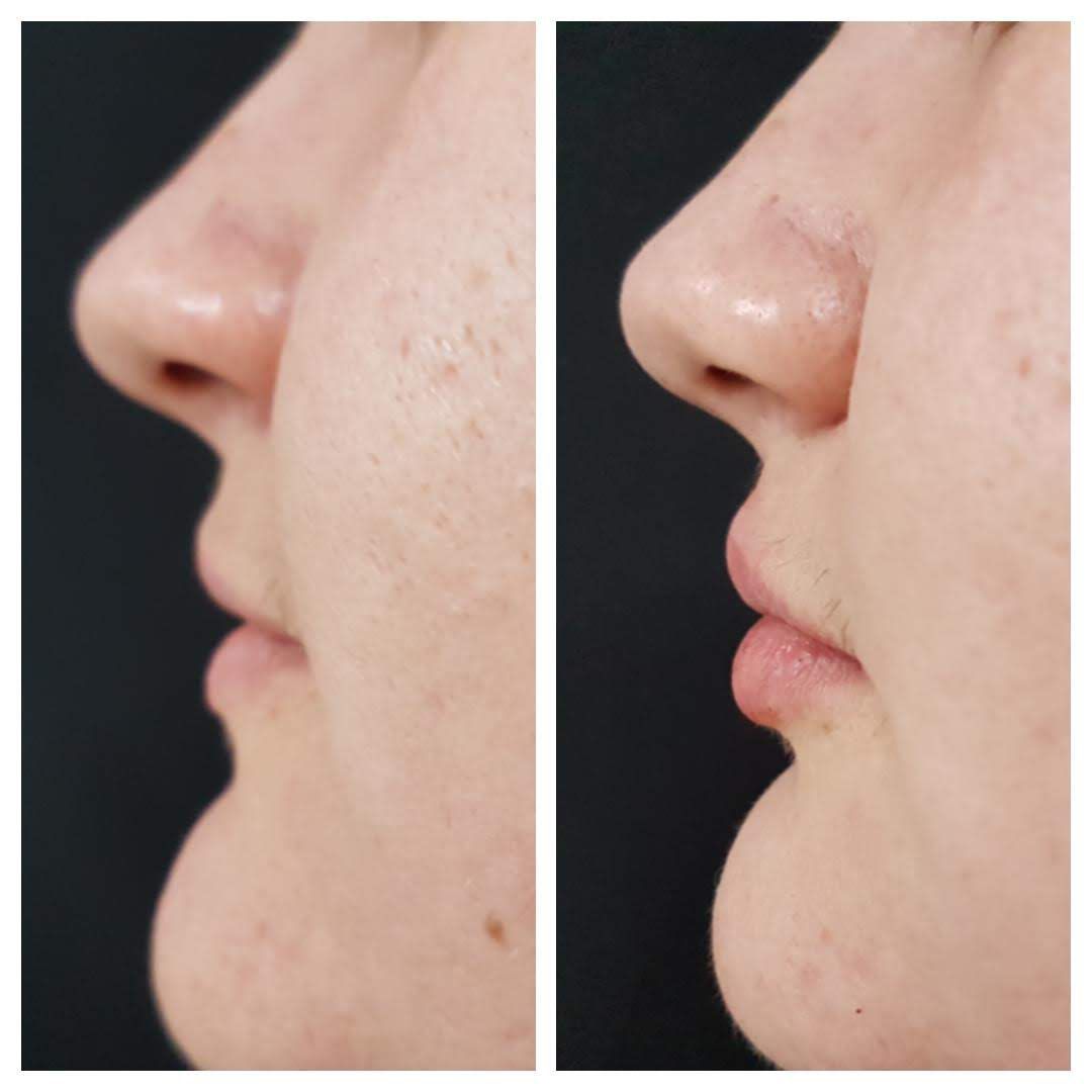 Resultado de harmonização facial — Clínica Essenziale